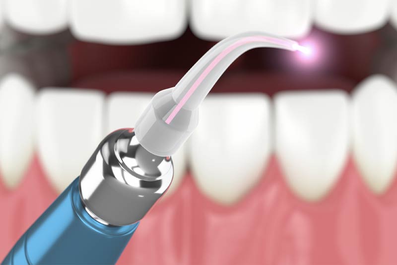 Soft Tissue Laser Dentistry in 