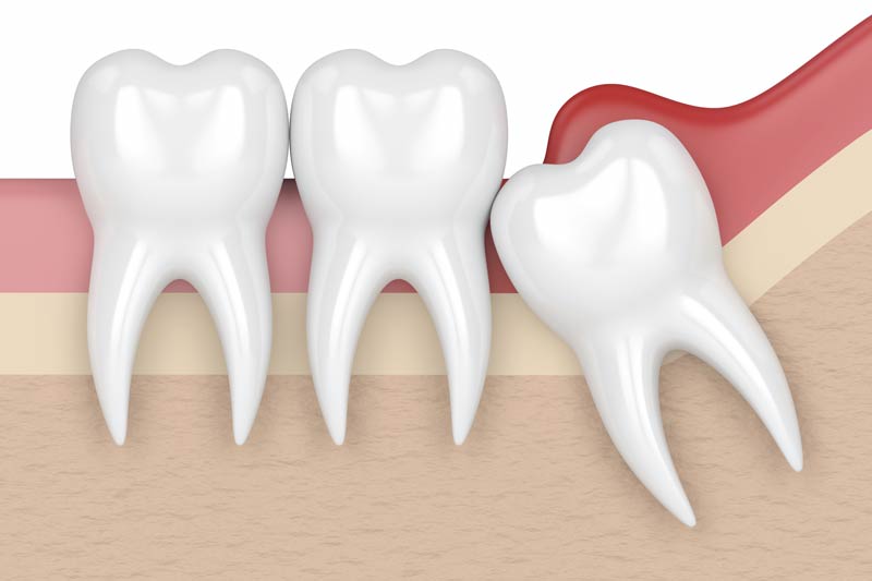 Wisdom Tooth Removal in Brooklyn